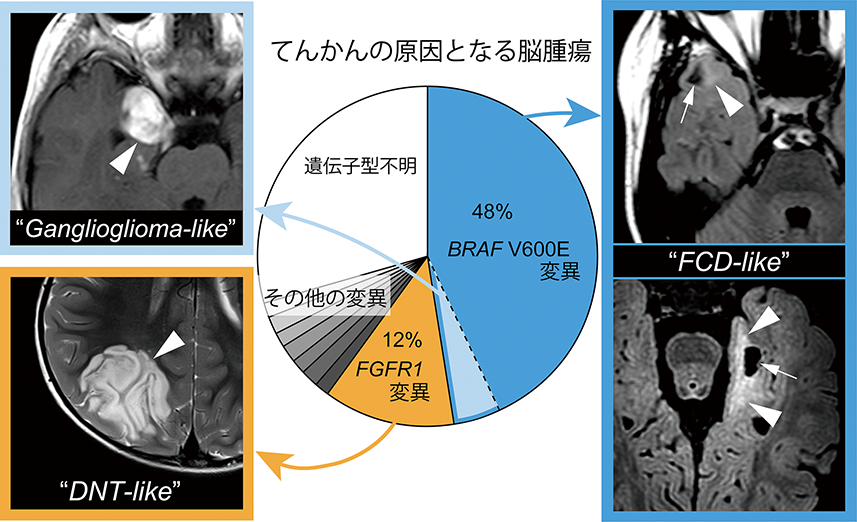 てんかんの原因となる脳腫瘍の図
