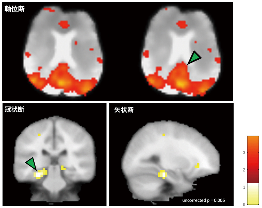 図2: アルツハイマー型認知症患者で見られた脳回路変調(当研究部らの予備検討)