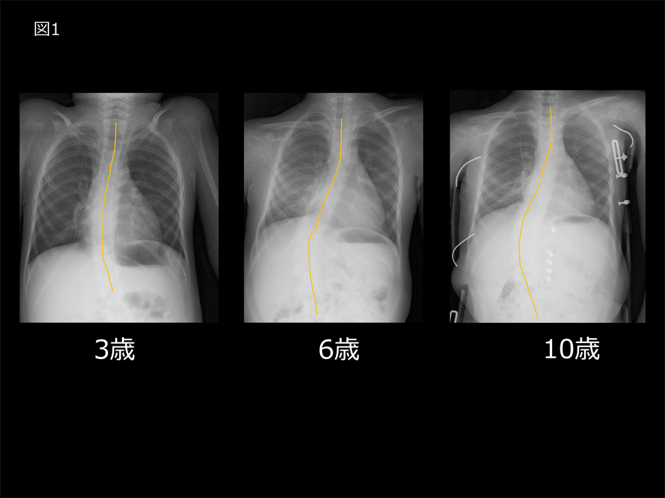 SMA患者の脊柱の継時的変化
