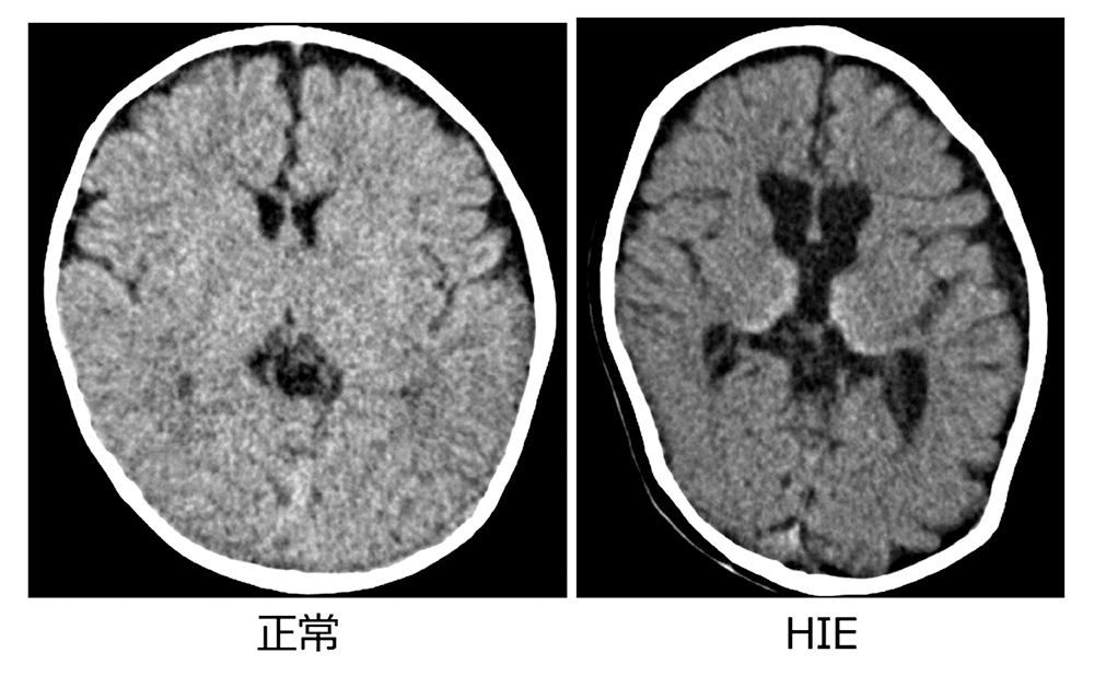 正常な脳とHIEの脳の比較画像