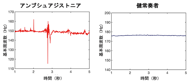 楽器演奏時の音声データでジストニア症状の可視化データ