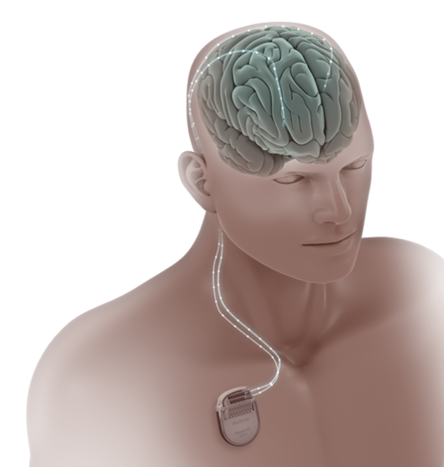 脳深部刺激療法（DBS）のイメージ図