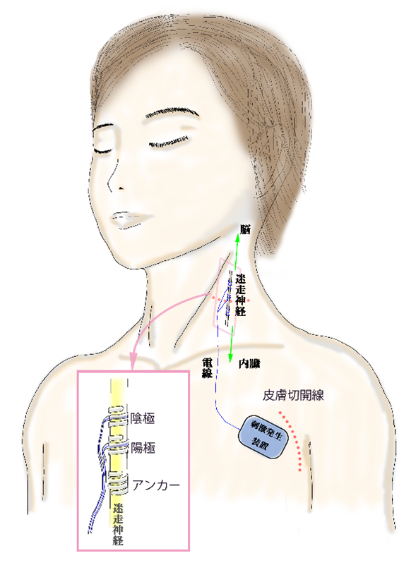 迷走神経刺激療法（VNS）のイメー