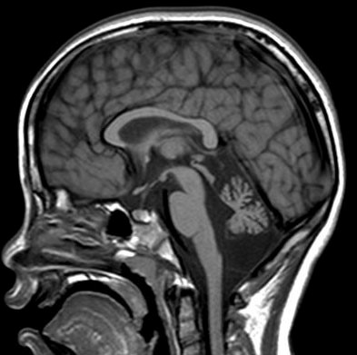 小脳皮質（全体）萎縮_矢状断