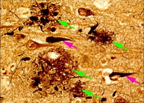 老人斑（緑矢印）とタウタンパク質からなる神経原線維変化（赤矢印）の顕微鏡画像