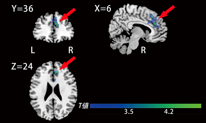 図1存命家族への共感に際し前帯状皮質（図内矢印で示した青い部分）の活動 が低い人ほど悲嘆症状が強いことを示す脳画像