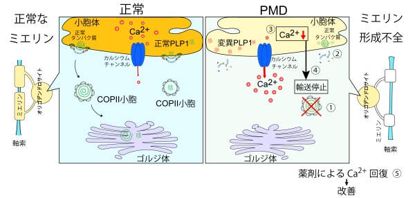 難病「ペリツェウス・メルツバッハ病」の原因に新説 ― “細胞内カルシウム不足”が細胞内物流を停止、治療の標的に ―