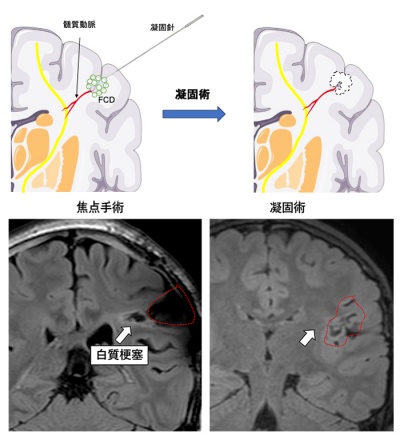 図1　RFTCの概念図と術後画像