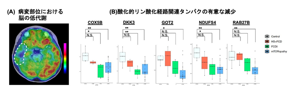 図2 難治てんかん病変部位の代謝低下と酸化的リン酸化関連タンパクの有意な減少