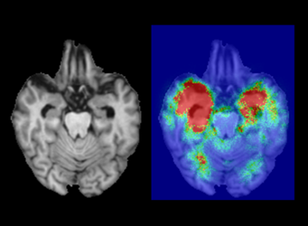 富士フイルムと国立精神・神経医療研究センター AI技術を用いて 軽度認知障害患者のアルツハイマー病への進行を最大88%の精度で予測 －国際学術誌「Nature」の関連誌「npj Digital Medicine」に掲載－