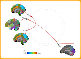 神経性やせ症（拒食症）の脳機能異常を網羅的に解明  世界初 多施設共同研究によるfMRIデータの大規模解析