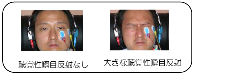 (左)聴覚性瞬目反射なし(右)大きな聴覚性瞬目反射