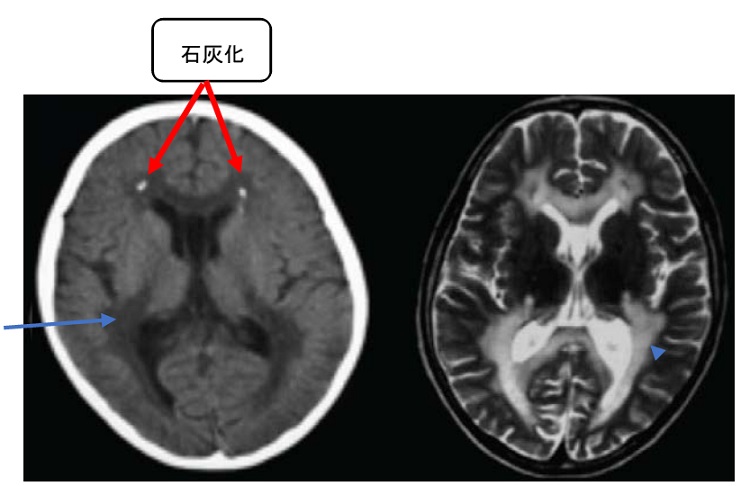 新生児期に発症する大脳白質変性症の原因遺伝子を世界で初めて発見