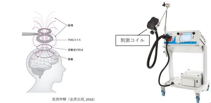 刺激コイル