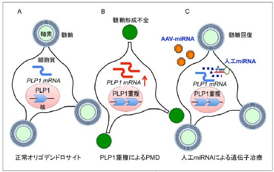 図1.PMDの原因と遺伝子治療の模式図