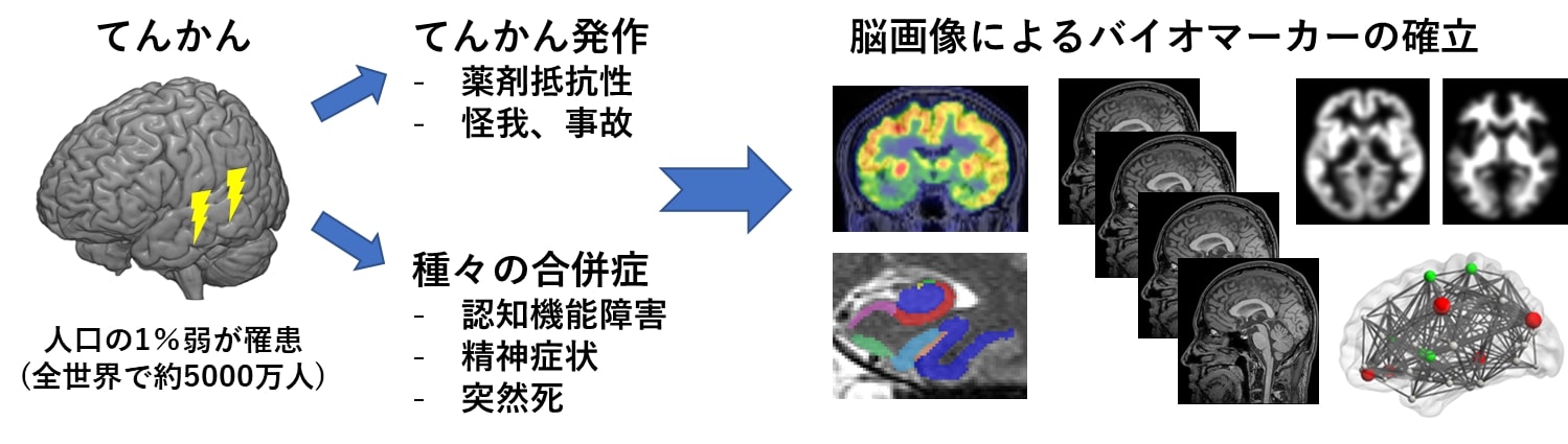 脳画像解析により、てんかん患者さんの予測脳年齢の亢進を発見 ～ 診断や治療効果の判定に有効か～