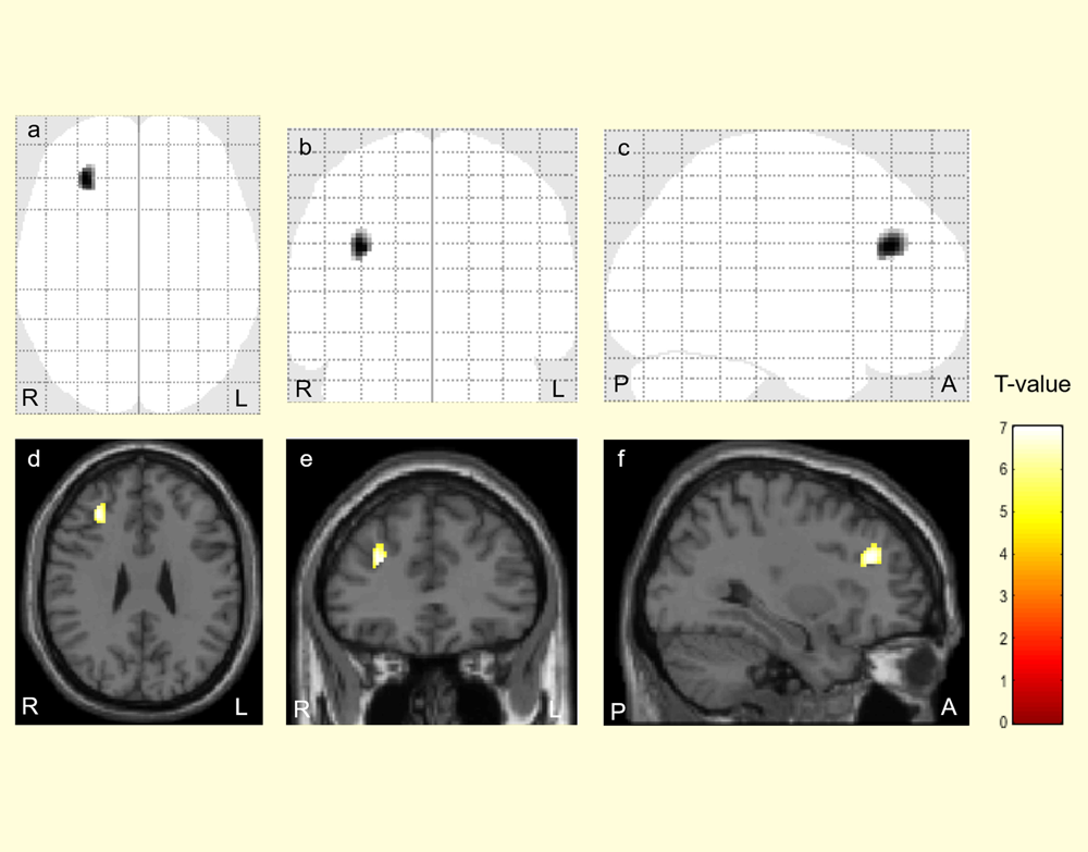 筋痛性脳脊髄炎 (ME/CFS)の自律神経受容体抗体に関連した 脳内構造ネットワーク異常を発見