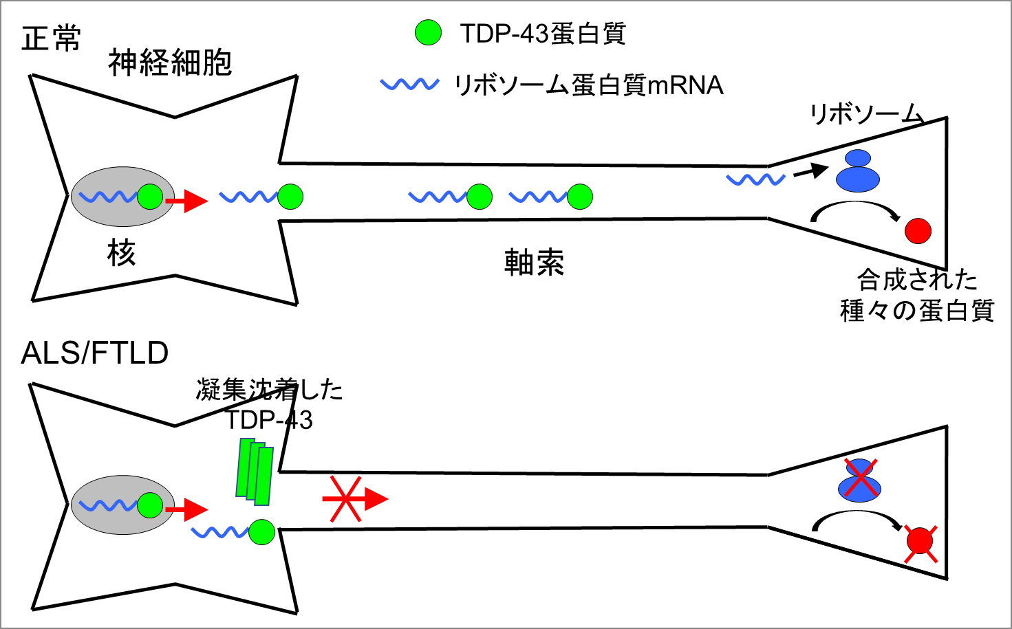 PLSとALSの症状はどのように異なりますか?