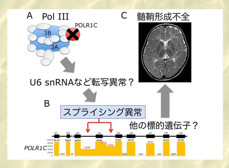 先天性大脳白質形成不全症の新たな病態メカニズムを発見 ～Pol III関連白質変性症のケースより～