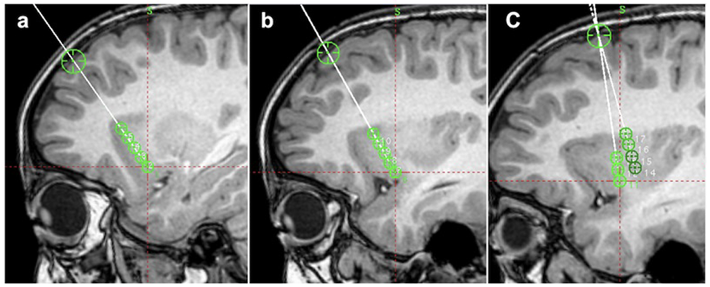 図２脳画像