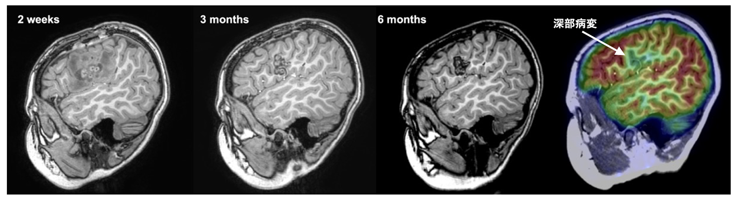 図3脳画像