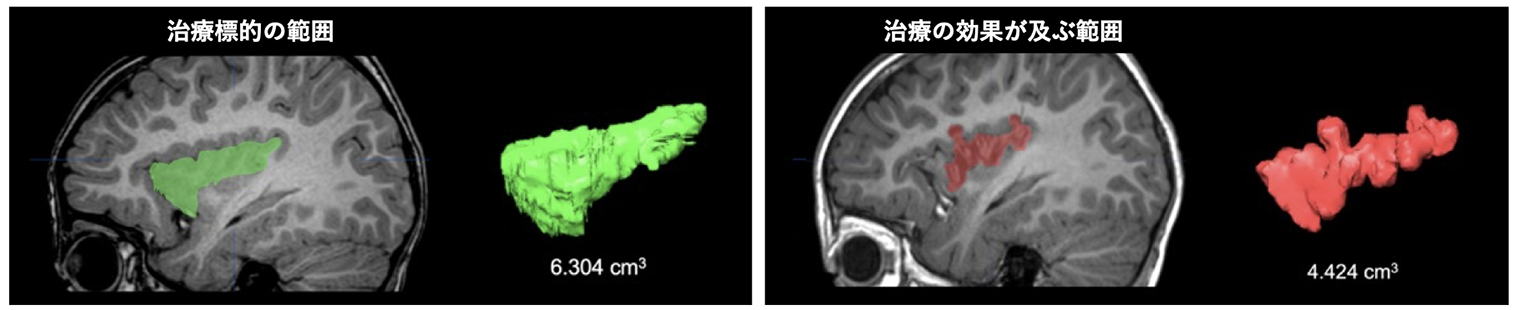 図４脳画像
