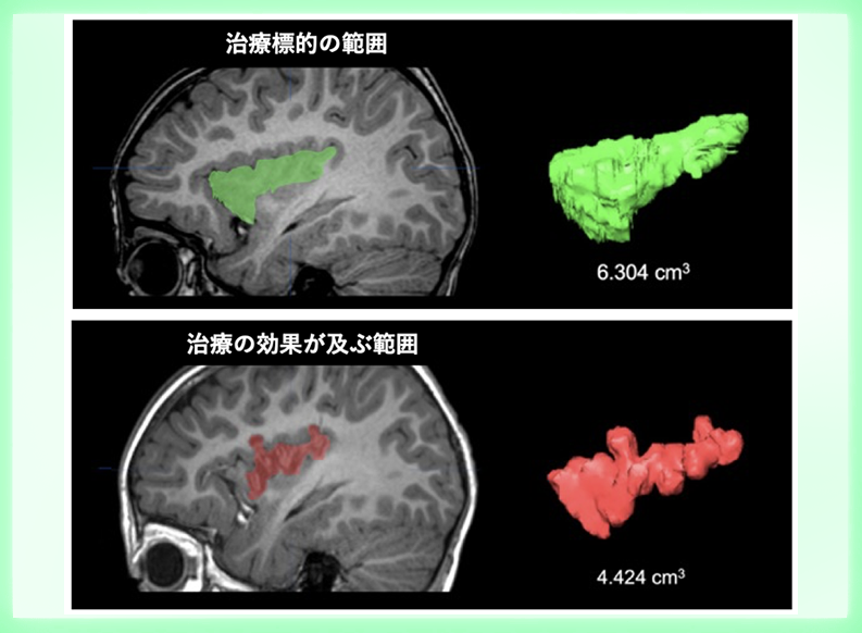 脳を切らない新しいてんかん外科治療に期待 〜ラジオ波てんかん焦点温熱凝固術〜