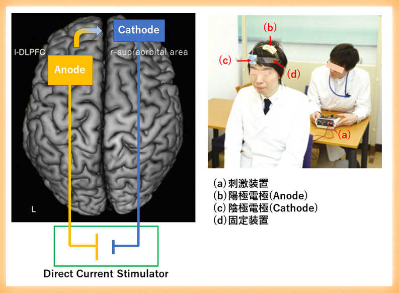 統合失調症の社会認知機能を経頭蓋直流刺激で改善  ～精神疾患を対象とした特定臨床研究～