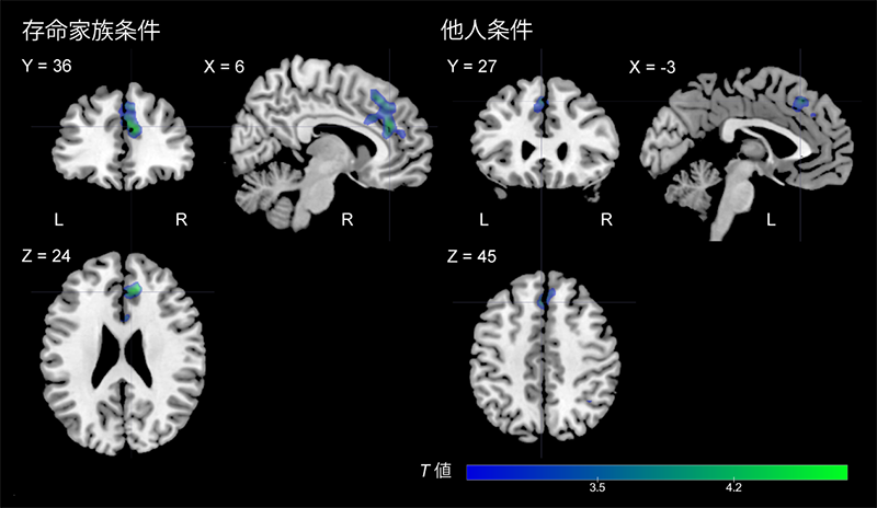 悲嘆症状との関連が示された顔刺激の種類と脳部位(共感回路)の脳画像