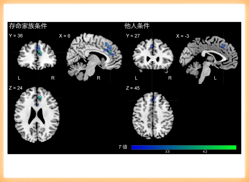 死別後に長引く悲嘆が共感性を抑制：悲嘆の脳科学的メカニズムを解明