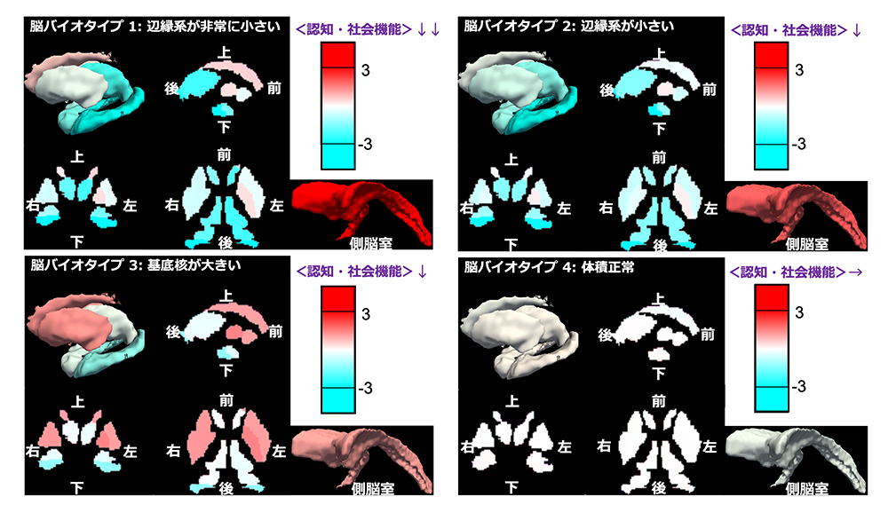 図2.　大脳皮質下領域構造の体積による4つの類型(脳バイオタイプ)