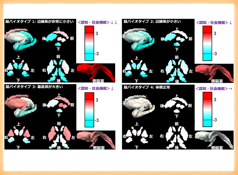 脳体積による精神疾患の新たな分類を提案 認知・社会機能と関連、精神疾患の新規診断法開発への発展に期待