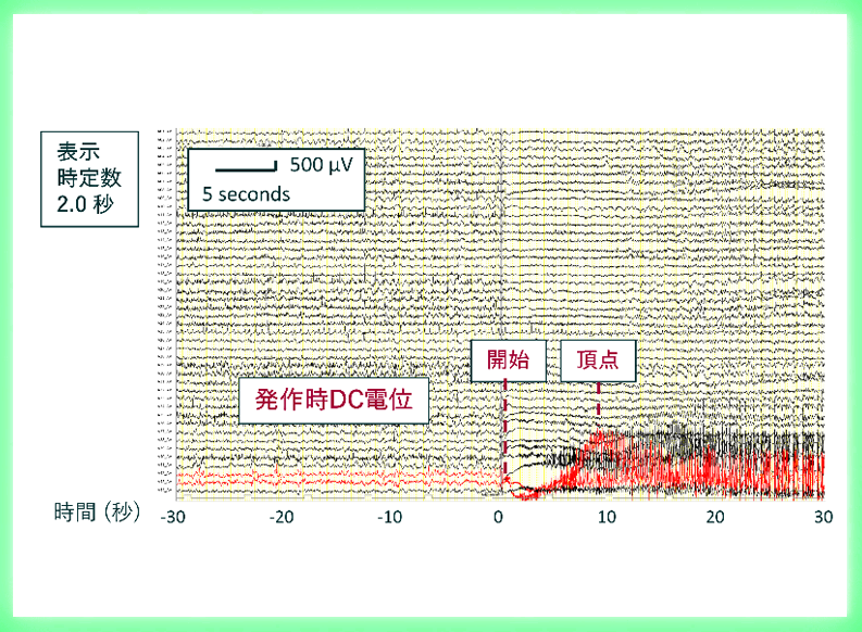 難治てんかん焦点の新しいバイオマーカー「発作時DC電位」世界で初めて時定数2秒でも有用であることを明らかに