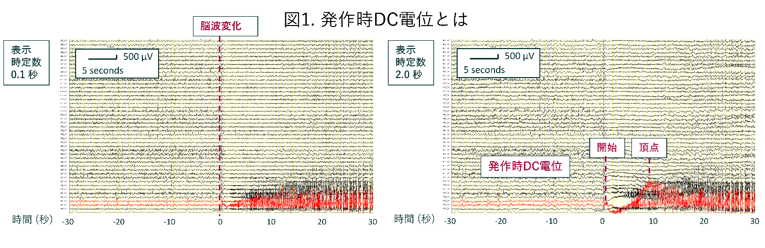 発作時DC電位を説明する脳波のグラフ