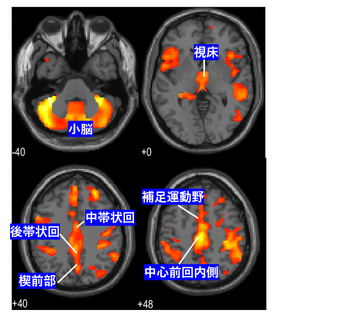 図１：拒食症患者で健常女性に比べて灰白質量が減少している脳部位の脳画像