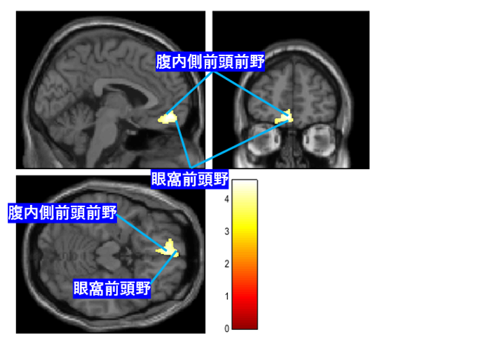 図2：拒食症の重症度と脳灰白質量とが正相関を示した脳部位の脳画像