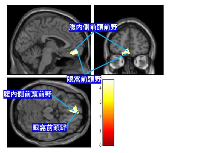 図2:拒食症の重症度と脳灰白質量とが正相関を示した脳部位の脳画像