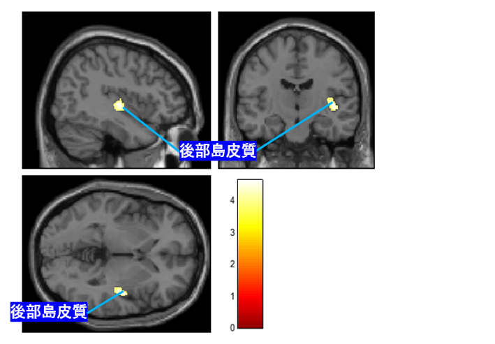 図3：拒食症の重症度と脳灰白質量とが正相関を示した脳部位の脳画像