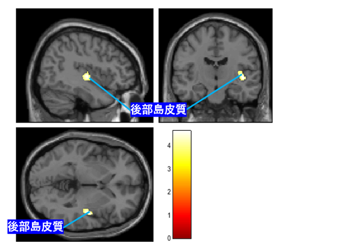 図3:拒食症の重症度と脳灰白質量とが正相関を示した脳部位の脳画像