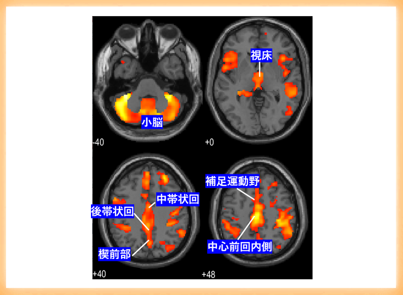 神経性やせ症（拒食症）における脳灰白質体積の減少と症状の重症度との関連を明らかに ～大規模共同研究が新たな知見を提供～